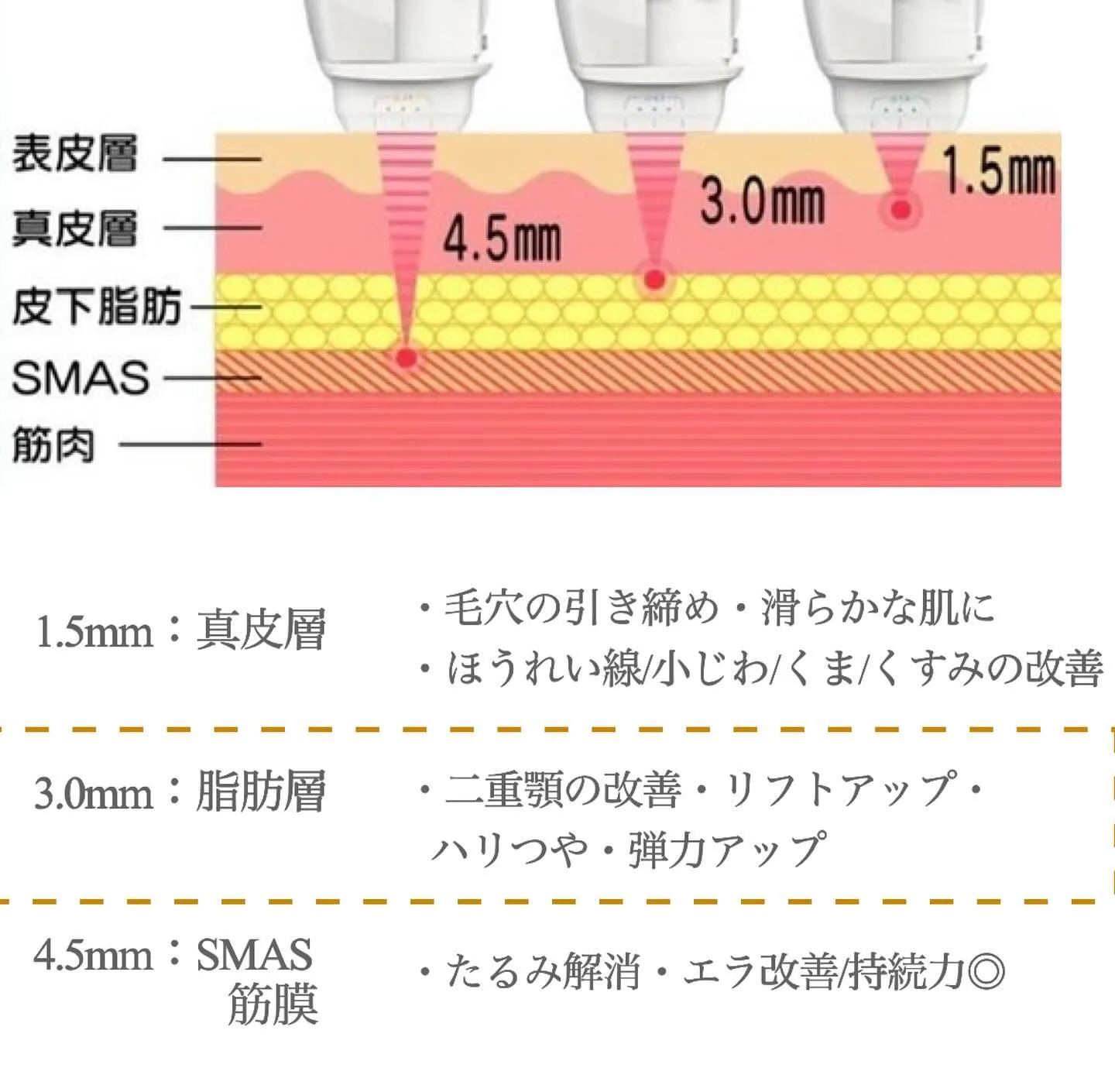 ＼　ハイフの3層アプローチとは？　／